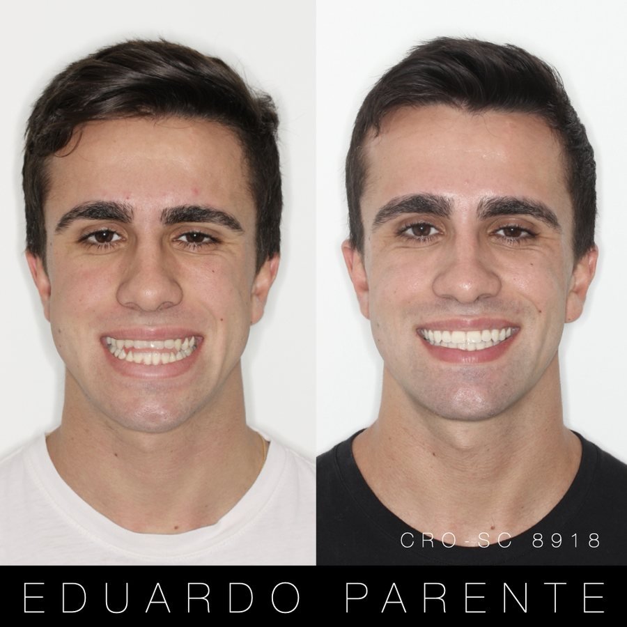 Antes e depois — Mordida aberta: face de frente antes (à esquerda) e depois (à direita) da cirurgia ortognática