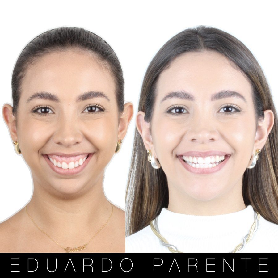Antes e depois — Sorriso gengival: sorriso de frente antes (à esquerda) e depois (à direita) da cirurgia ortognática