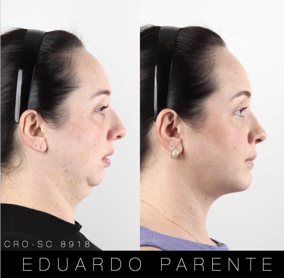Antes e depois — Classe II: perfil facial antes (à esquerda) e depois (à direita) da cirurgia ortognática