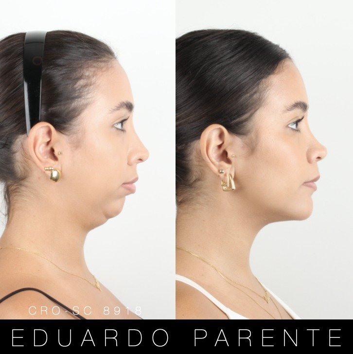 Antes e depois — Classe II: perfil facial antes (à esquerda) e depois (à direita) da cirurgia ortognática
