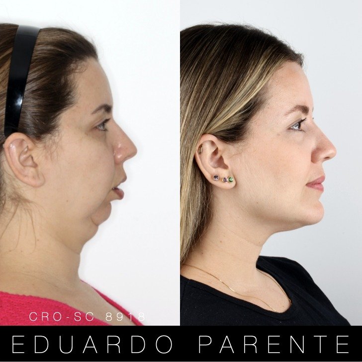 Antes e depois — Classe II: perfil facial antes (à esquerda) e depois (à direita) da cirurgia ortognática