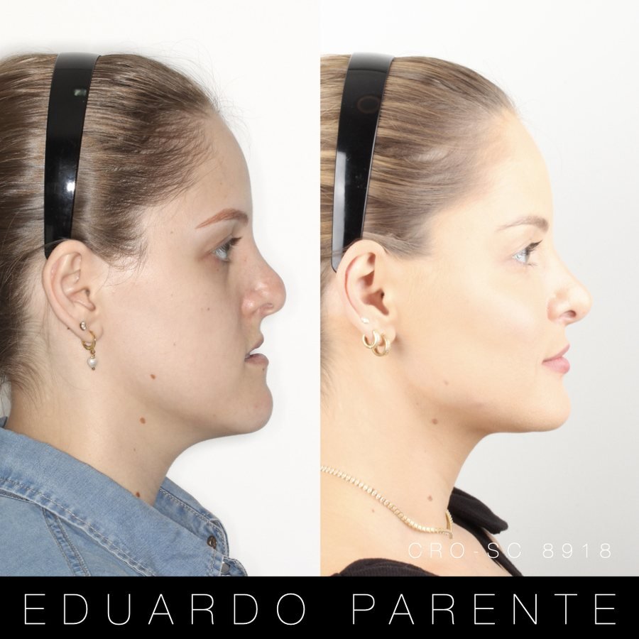 Antes e depois — Classe III: perfil facial antes (à esquerda) e depois (à direita) da cirurgia ortognática