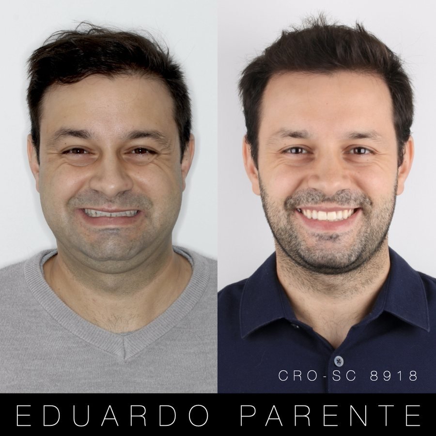 Antes e depois — Classe II: face de frente antes (à esquerda) e depois (à direita) da cirurgia ortognática