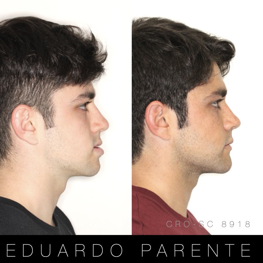 Antes e depois — Classe III: perfil facial antes (à esquerda) e depois (à direita) da cirurgia ortognática