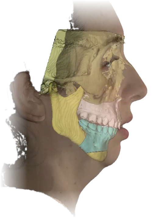Perfil da paciente na tomografia antes da cirurgia: maxila em amarelo e mandíbula em azul, com o queixo recuado