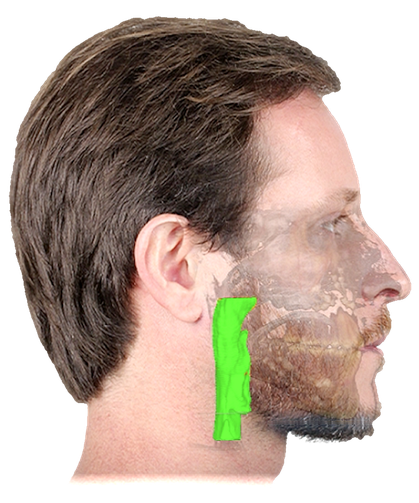 O mesmo paciente depois da cirurgia: a coluna de ar atrás da língua aparece larga e contínua, toda em verde.