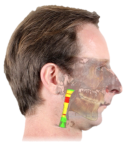 Perfil do paciente antes da cirurgia, com a tomografia sobreposta: a coluna de ar atrás da língua aparece estreita, em amarelo e vermelho.